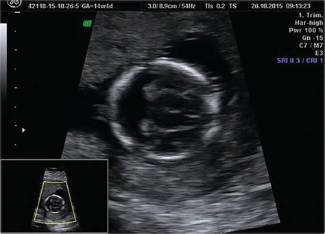 how accurate is dating scan at 9 weeks